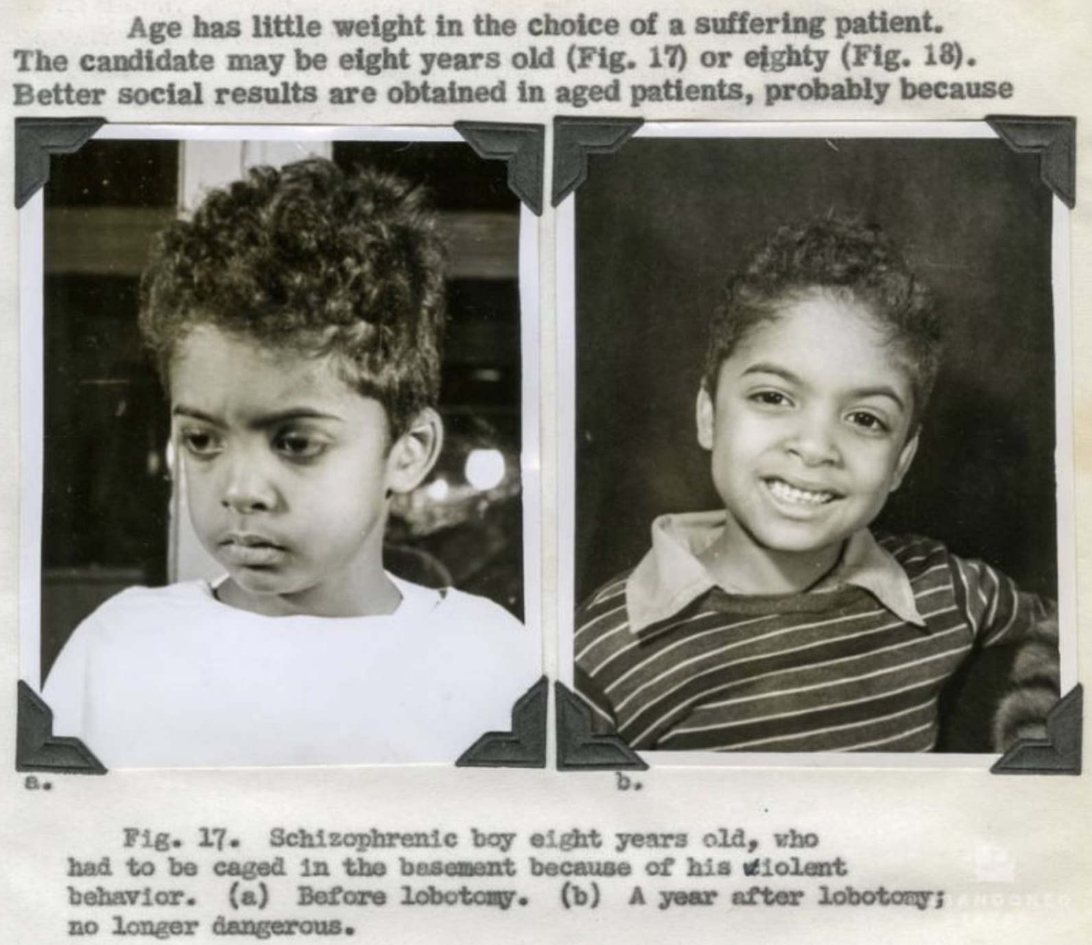 Antes e depois. 22 fotos assustadoras de pessoas que fizeram uma lobotomia