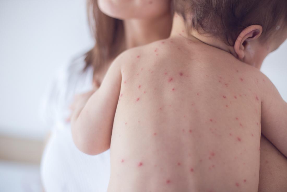 Sarampo pode apagar até 73% da memória imunológica — e deixar-nos mais suscetíveis a doenças
