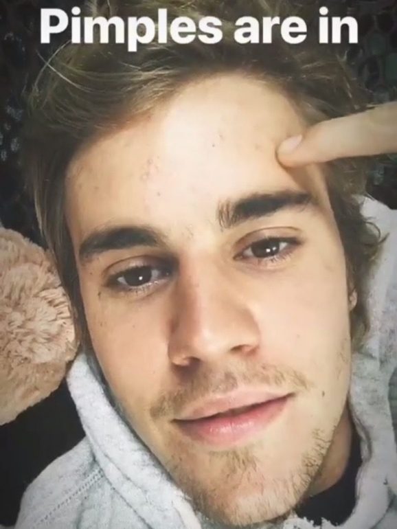 Justin Bieber fez um InstaStories a mostrar as suas borbulhas