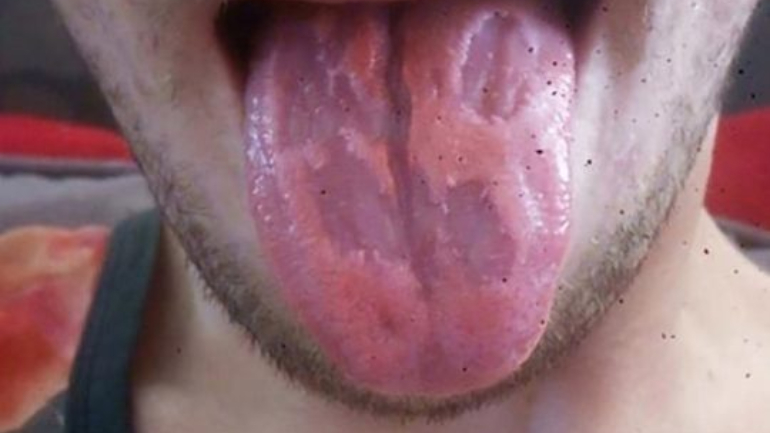A fotografia de Dan Royals com a língua danificada 