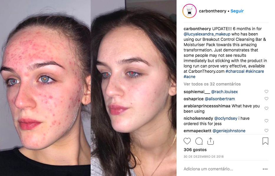 O sabonete de 7€ que está a mudar a pele de quem sofre de acne severo