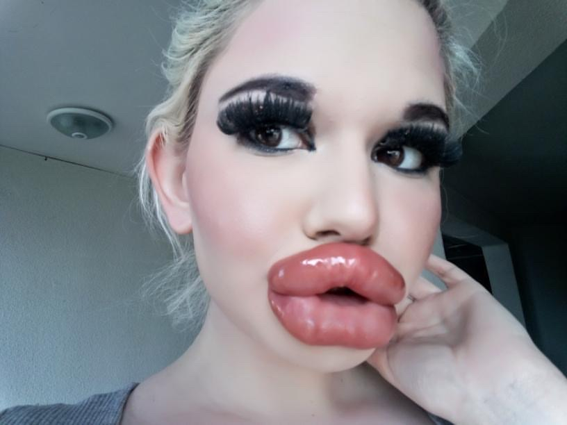 À vigésima injeção labial conseguiu ter os maiores lábios do mundo — veja as fotos da evolução