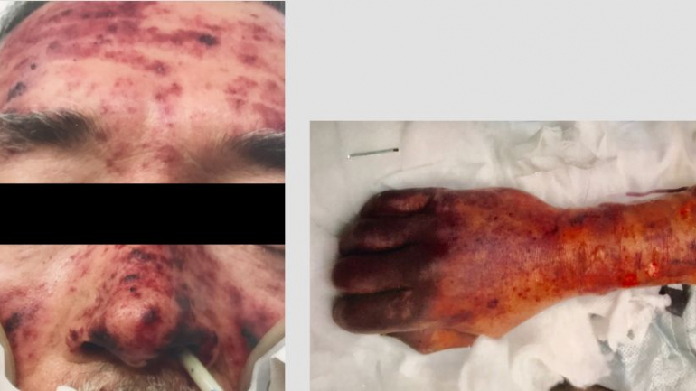 O homem de 63 começou a desenvolver uma erupção cutânea na cara e a pele deteriorou-se ao longo do tempo
