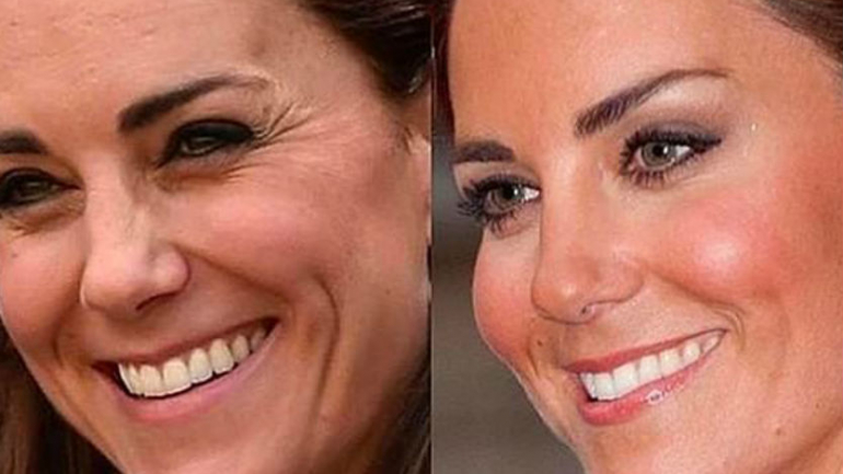 Clínica usa fotos de antes e depois de Kate Middleton para promover os seus liftings faciais