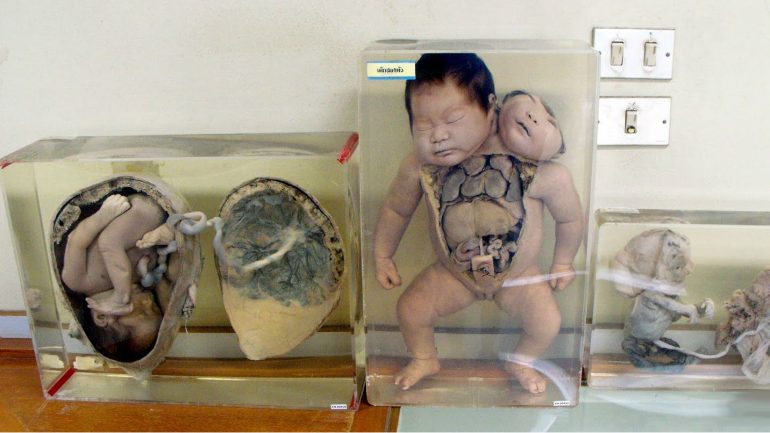 Os fetos são reais e estão expostos em recipientes como estes um pouco pelas várias salas do museu