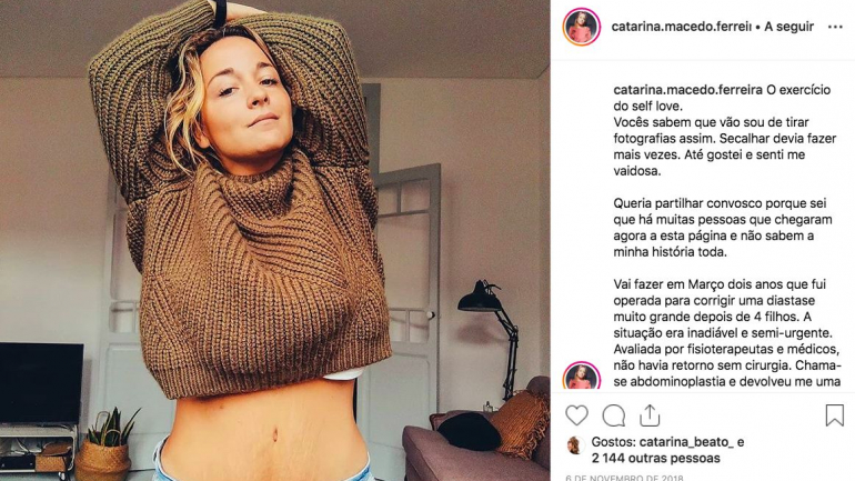 Catarina Macedo Ferreira, dois anos depois de ter feito uma abdominoplastia por causa da sua diástase abdominal acentuada.